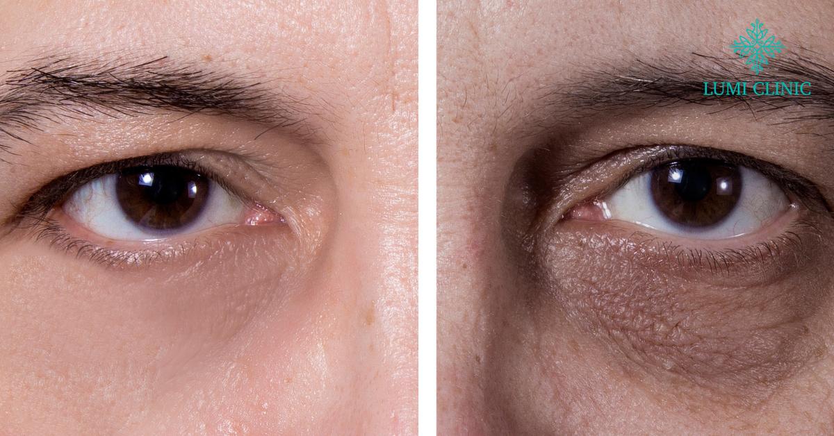 Erase the Signs of Fatigue Overnight: Eyebag Treatment