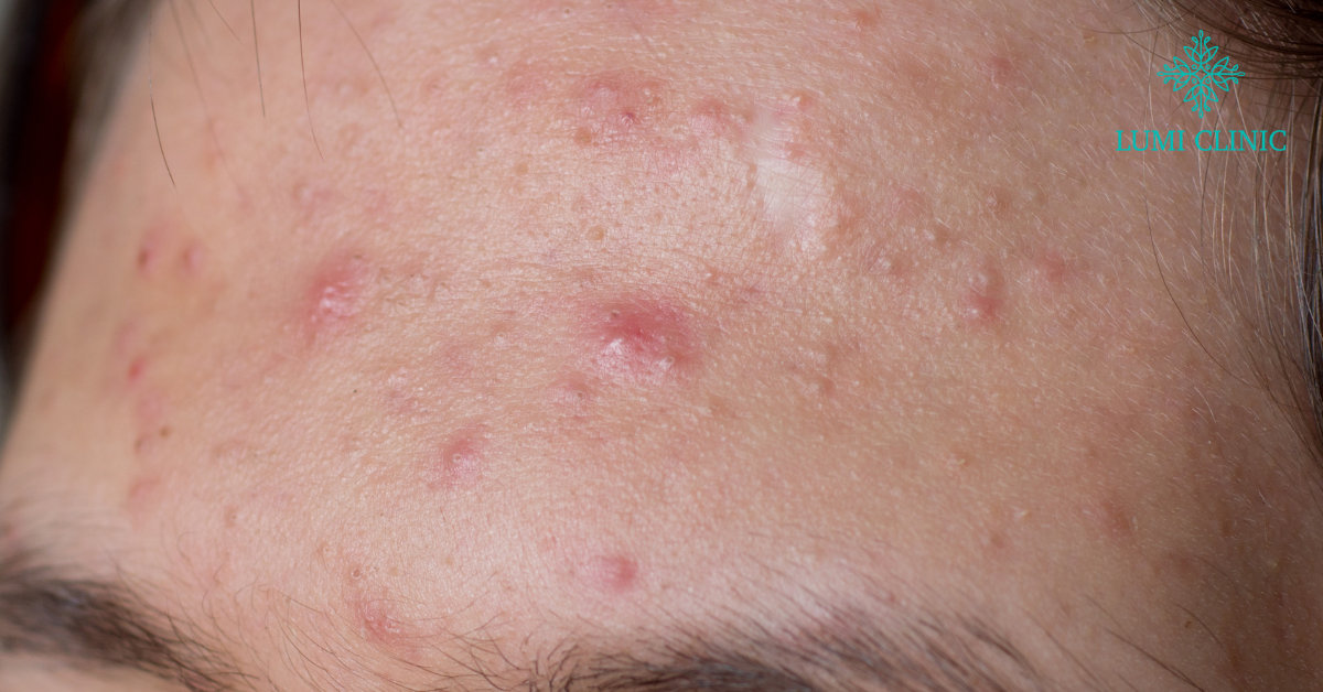 Facial Treatment_ Say Goodbye to Breakouts and Blemishes