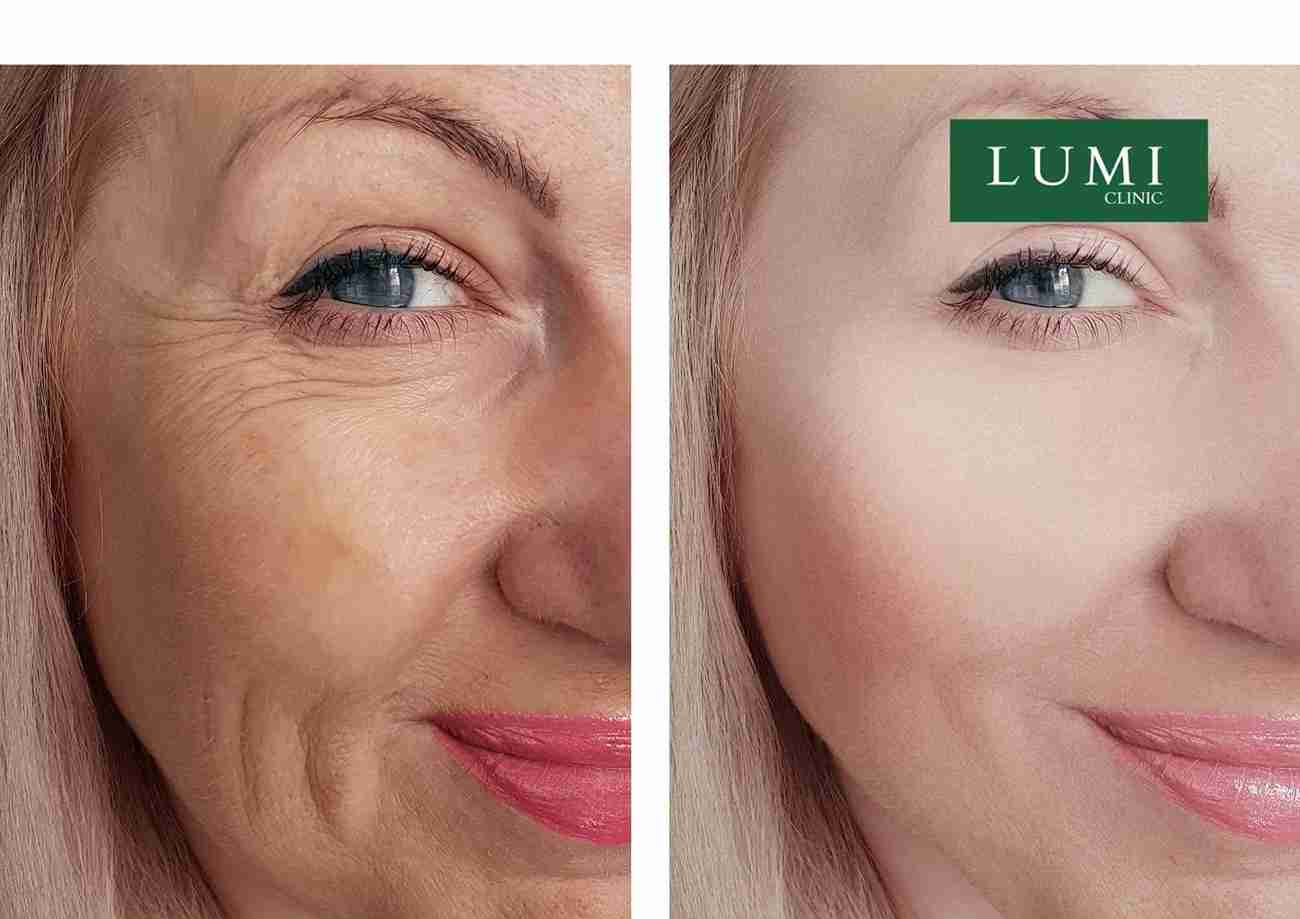 Facial treatment